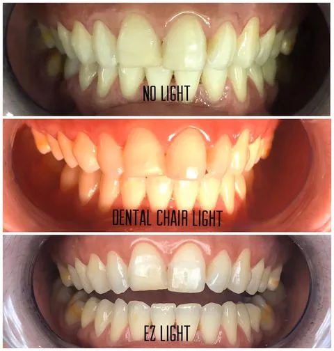 EZ Light Mobile Dental Photography