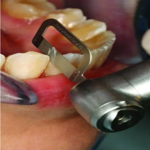 Ortho Interproximal Stripping Contra Angle Handpiece 4 1 Reduction